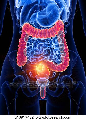 Stock Image - Bowel cancer, conceptual illustration. Fotosearch