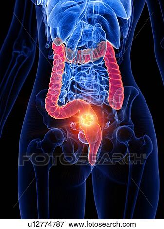 Stock Photo - Bowel cancer, conceptual illustration. Fotosearch