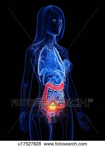 Bowel cancer, conceptual illustration View Large Photo Image Stock Photo - Bowel cancer, conceptual illustration. Fotosearch