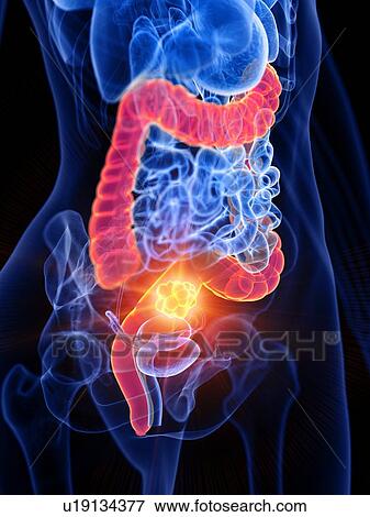 Bowel cancer, conceptual illustration View Large Photo Image Stock Photo - Bowel cancer, conceptual illustration. Fotosearch