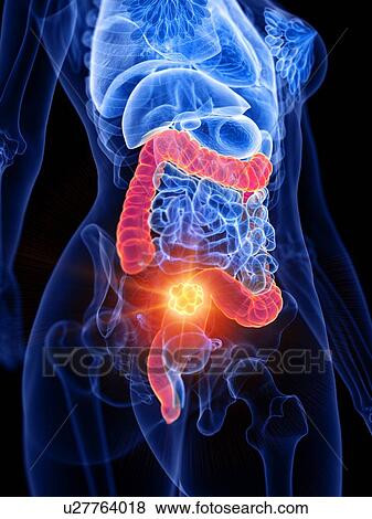 Stock Photo - Bowel cancer, conceptual illustration. Fotosearch