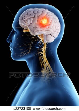 Brain cancer, conceptual computer illustration. View Large Photo Image Stock Image - Brain cancer, conceptual computer illustration.. Fotosearch