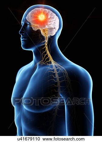 Stock Image - Brain cancer, conceptual computer illustration.. Fotosearch
