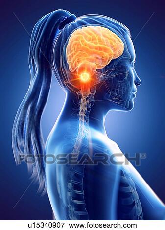 Brain cancer, conceptual computer illustration. View Large Photo Image Stock Photo - Brain cancer, conceptual computer illustration.. Fotosearch