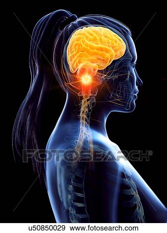 Stock Photo - Brain cancer, conceptual computer illustration.. Fotosearch