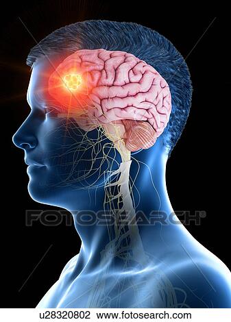 Stock Image - Brain tumour, conceptual computer illustration.. Fotosearch
