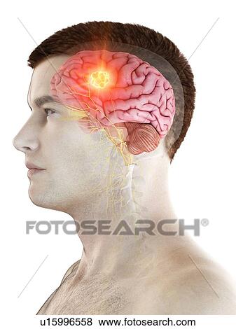 Stock Photo - Brain tumour, conceptual computer illustration.. Fotosearch