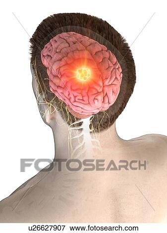 Brain tumour, conceptual computer illustration. View Large Photo Image Stock Photo - Brain tumour, conceptual computer illustration.. Fotosearch