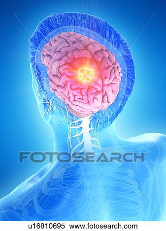 Stock Photography - Brain tumour, conceptual computer illustration.. Fotosearch