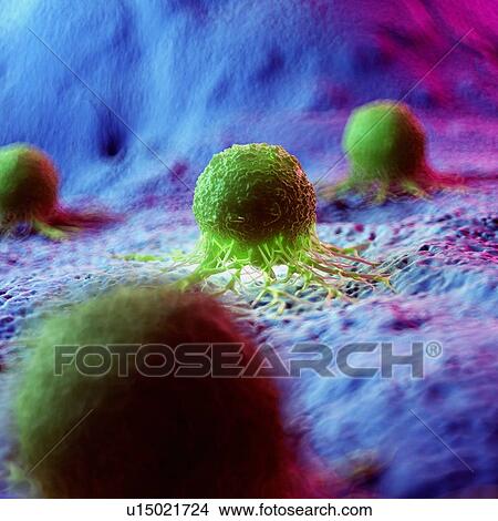 Cancer cells, computer illustration. View Large Photo Image Picture - Cancer cells, computer illustration.. Fotosearch