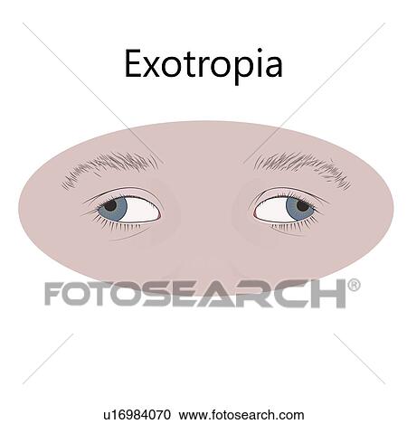 Stock Image - Childhood exotropia, illustration.. Fotosearch