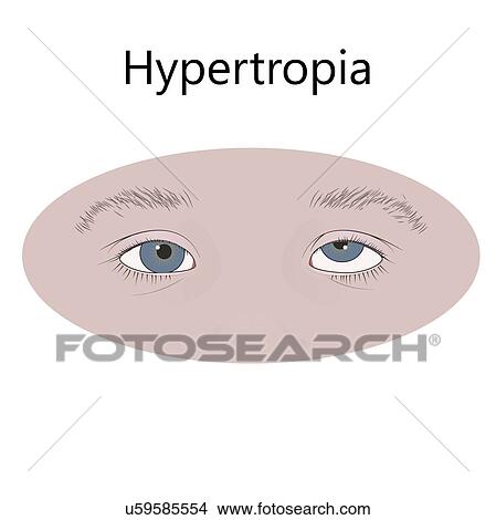 Picture - Childhood hypertropia, illustration.. Fotosearch