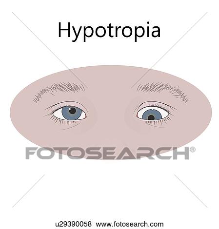 Stock Photo - Childhood hypotropia, illustration.. Fotosearch