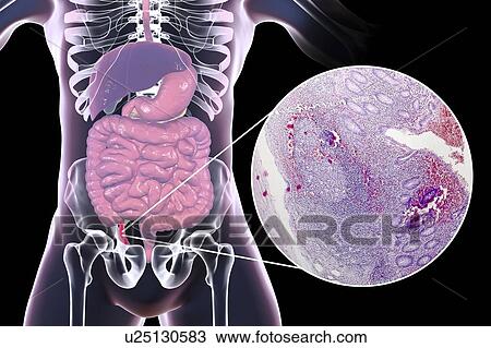 Chronic appendicitis, computer illustration and light micrograph. Illustration of a human appendix that is red and inflamed in appendicitis. The appendix is a narrow finger-shaped tube that branches off the first part of the large intestine (caecum,... View Large Photo Image Stock Image - Chronic appendicitis, computer illustration and light micrograph. Illustration of a human appendix that is red and inflamed in appendicitis. The appendix is a narrow finger-shaped tube that branches off the first part of the large intestine (caecum,.... Fotosearch
