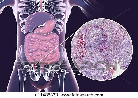 Chronic appendicitis, computer illustration and light micrograph. Illustration of a human appendix that is red and inflamed in appendicitis. The appendix is a narrow finger-shaped tube that branches off the first part of the large intestine (caecum,... View Large Photo Image Stock Photo - Chronic appendicitis, computer illustration and light micrograph. Illustration of a human appendix that is red and inflamed in appendicitis. The appendix is a narrow finger-shaped tube that branches off the first part of the large intestine (caecum,.... Fotosearch