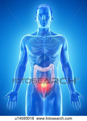 Stock Photo - Colon cancer, conceptual computer illustration.. Fotosearch