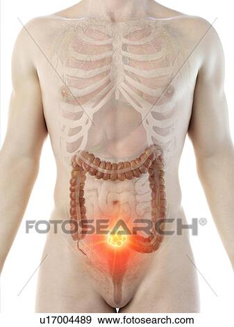 Stock Photo - Colon cancer, conceptual computer illustration.. Fotosearch