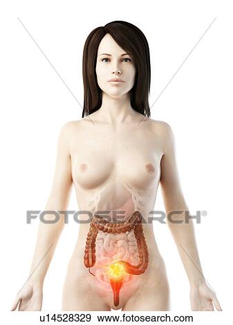 Colon cancer, conceptual illustration View Large Photo Image Stock Photo - Colon cancer, conceptual illustration. Fotosearch