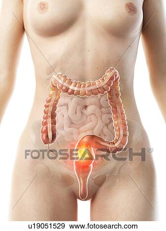 Colon cancer, conceptual illustration View Large Photo Image Stock Photo - Colon cancer, conceptual illustration. Fotosearch