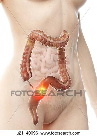 Colon cancer, conceptual illustration View Large Photo Image Stock Photograph - Colon cancer, conceptual illustration. Fotosearch