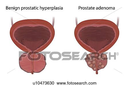 Comparison of benign prostatic hyperplasia and prostate adenoma, illustration. Benign prostatic hyperplasia is a non-cancerous enlargement of the prostate gland. View Large Photo Image Stock Image - Comparison of benign prostatic hyperplasia and prostate adenoma, illustration. Benign prostatic hyperplasia is a non-cancerous enlargement of the prostate gland.. Fotosearch