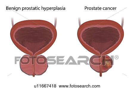 Stock Photo - Comparison of benign prostatic hyperplasia and prostate cancer, illustration. Benign prostatic hyperplasia is a non-cancerous enlargement of the prostate gland.. Fotosearch