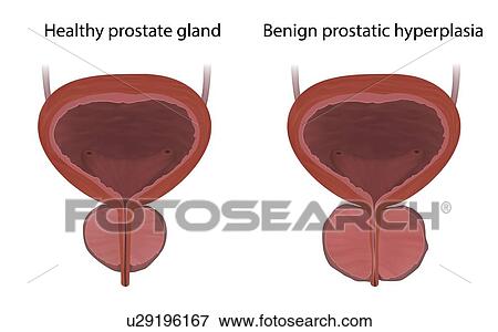 Comparison of benign prostatic hyperplasia and a healthy prostate gland, illustration. Benign prostatic hyperplasia is a non-cancerous enlargement of the prostate gland. View Large Photo Image Stock Photo - Comparison of benign prostatic hyperplasia and a healthy prostate gland, illustration. Benign prostatic hyperplasia is a non-cancerous enlargement of the prostate gland.. Fotosearch