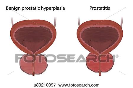Comparison of benign prostatic hyperplasia and prostatitis, illustration. Prostatitis is the inflammation of the prostate gland. Benign prostatic hyperplasia is a non-cancerous enlargement of the prostate gland. View Large Photo Image Stock Photo - Comparison of benign prostatic hyperplasia and prostatitis, illustration. Prostatitis is the inflammation of the prostate gland. Benign prostatic hyperplasia is a non-cancerous enlargement of the prostate gland.. Fotosearch