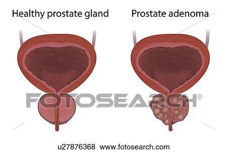 Stock Photo - Comparison of prostate adenoma and a healthy prostate gland, illustration.. Fotosearch
