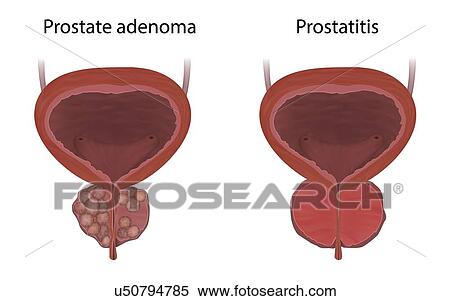 Comparison of prostate adenoma and prostatitis, illustration. Prostatitis is the inflammation of the prostate gland. View Large Photo Image Stock Photography - Comparison of prostate adenoma and prostatitis, illustration. Prostatitis is the inflammation of the prostate gland.. Fotosearch