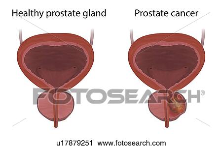 Stock Image - Comparison of prostate cancer and a healthy prostate gland, illustration.. Fotosearch