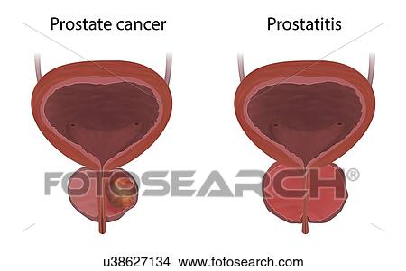 Picture - Comparison of prostate cancer and prostatitis, illustration. Prostatitis is the inflammation of the prostate gland.. Fotosearch