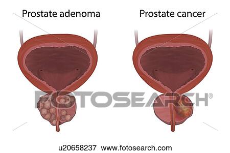 Stock Photo - Comparison of prostate cancer and adenoma, illustration.. Fotosearch