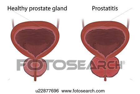 Comparison of prostatitis and a healthy prostate gland, illustration. Prostatitis is the inflammation of the prostate gland. View Large Photo Image Stock Photograph - Comparison of prostatitis and a healthy prostate gland, illustration. Prostatitis is the inflammation of the prostate gland.. Fotosearch