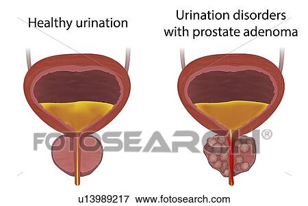 Stock Photo - Comparison of urinary disorders with prostate adenoma and healthy urination, illustration.. Fotosearch