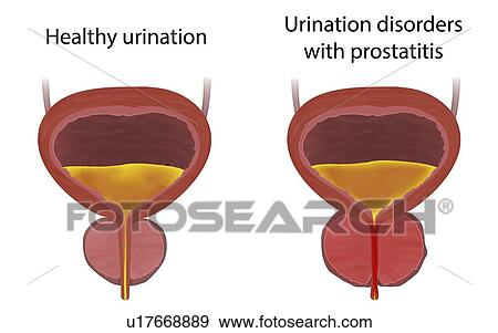 Comparison of urinary disorders with prostatitis and healthy urination, illustration. View Large Photo Image Stock Photo - Comparison of urinary disorders with prostatitis and healthy urination, illustration.. Fotosearch