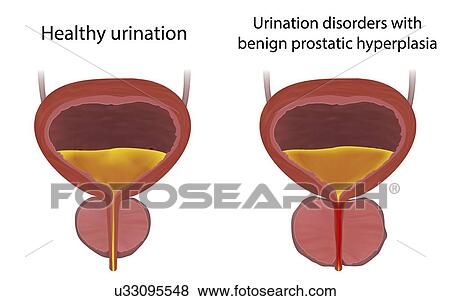 Stock Photo - Comparison of urinary disorders with benign prostatic hyperplasia and healthy urination, illustration.. Fotosearch