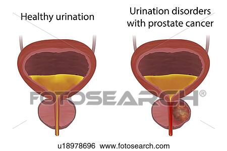 Stock Photograph - Comparison of urinary disorders with prostate cancer and healthy urination, illustration.. Fotosearch