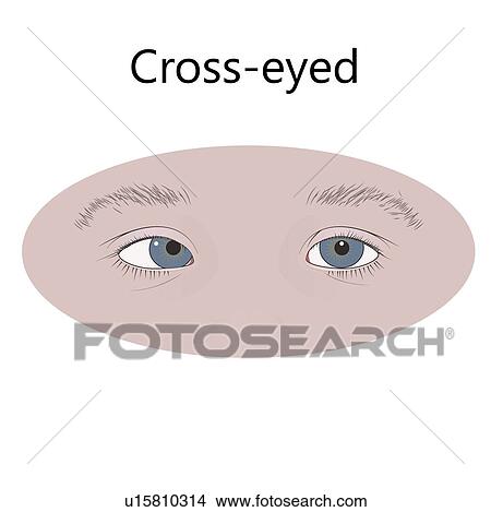 Cross-eyed child, illustration. Strabismus, esotropia, inward eyes. View Large Photo Image Picture - Cross-eyed child, illustration. Strabismus, esotropia, inward eyes.. Fotosearch