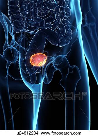 Diseased bladder, conceptual illustration View Large Photo Image Picture - Diseased bladder, conceptual illustration. Fotosearch