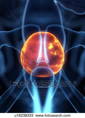 Stock Image - Diseased bladder, conceptual illustration. Fotosearch