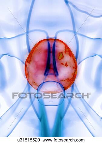 Stock Image - Diseased bladder, conceptual illustration. Fotosearch