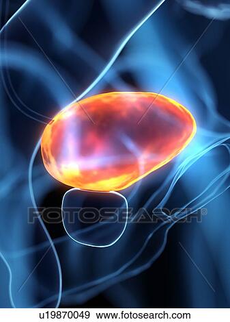 Stock Photo - Diseased bladder, conceptual illustration. Fotosearch