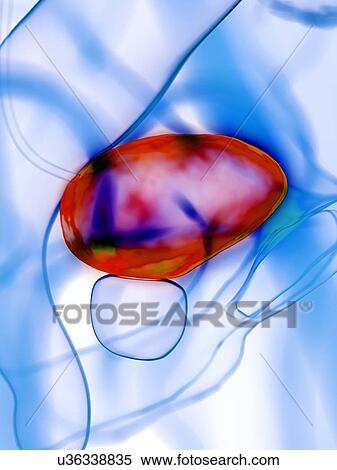Diseased bladder, conceptual illustration View Large Photo Image Stock Photography - Diseased bladder, conceptual illustration. Fotosearch