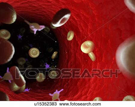 Stock Image - Diseased blood cells, computer illustration.. Fotosearch