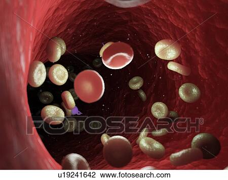 Diseased blood cells, computer illustration. View Large Photo Image Stock Image - Diseased blood cells, computer illustration.. Fotosearch
