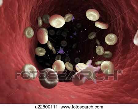 Stock Image - Diseased blood cells, computer illustration.. Fotosearch
