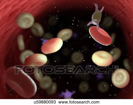 Stock Image - Diseased blood cells, computer illustration.. Fotosearch