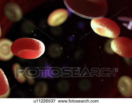 Stock Photo - Diseased blood cells, computer illustration.. Fotosearch