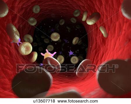 Diseased blood cells, computer illustration. View Large Photo Image Stock Photo - Diseased blood cells, computer illustration.. Fotosearch